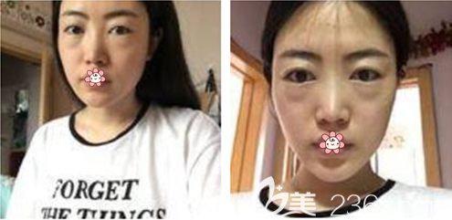 术前的我 术前的我