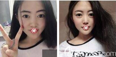 <!--<i data=20240703-sp></i>-->内切祛眼袋术后半个月 <!--<i data=20240703-sp></i>-->内切祛眼袋术后半个月