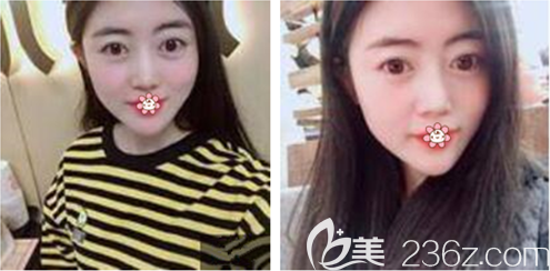 刘德东祛眼袋术后2个月