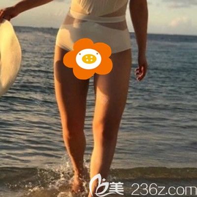 在<!--<i data=20240703-sp></i>-->做大腿吸脂前我的大粗腿 在<!--<i data=20240703-sp></i>-->做大腿吸脂前我的大粗腿