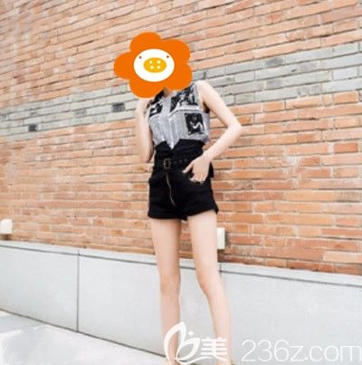 做完吸脂瘦腿半个月没穿塑腿裤 做完吸脂瘦腿半个月没穿塑腿裤