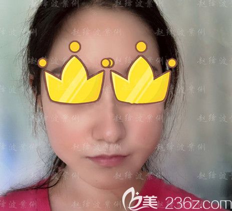 做下颌角整形手术前 做下颌角整形手术前