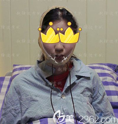 做完下颌角整形手术当天 做完下颌角整形手术当天