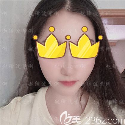 下颌角整形手术1个月 下颌角整形手术1个月