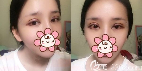 切开双眼皮+开内眼角+去脂的眼部综合术后即刻 切开双眼皮+开内眼角+去脂的眼部综合术后即刻
