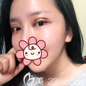 术后三天眼部整形恢复效果 术后三天眼部整形恢复效果