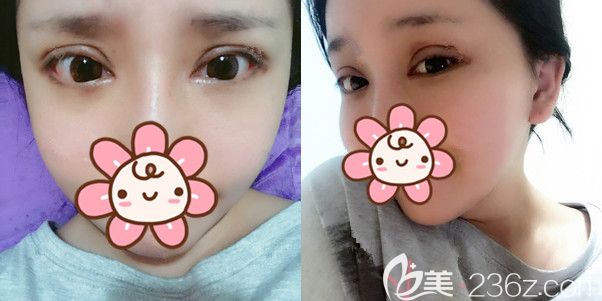 一周到泰州丽都拆线眼睛已经基本消肿 一周到泰州丽都拆线眼睛已经基本消肿