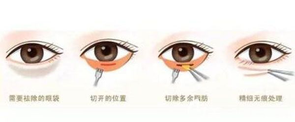 爱思特王楷医生做祛眼袋手术过程