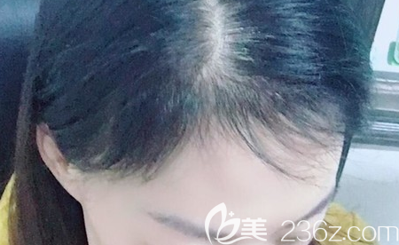 重庆华肤医院孙乘林植发2555单位5个月效果