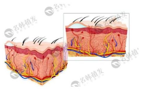 济南名韩植发技术原理 济南名韩植发技术原理