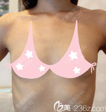 韩国艾恩术前自拍照 韩国艾恩术前自拍照