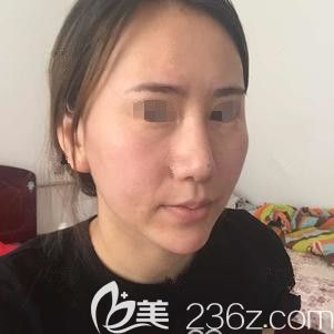 术前面部凹陷明显显老 术前面部凹陷明显显老