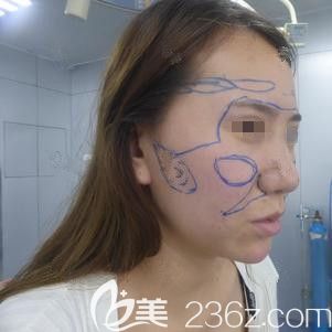 华美医生圈出来自体脂肪填充区域 华美医生圈出来自体脂肪填充区域