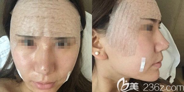 刚做完面部脂肪填充术后包着纱布 刚做完面部脂肪填充术后包着纱布