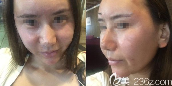 全麻做自体脂肪填充面部术后三天肿胀 全麻做自体脂肪填充面部术后三天肿胀