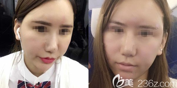 一周后自体脂肪填充面部恢复情况 一周后自体脂肪填充面部恢复情况