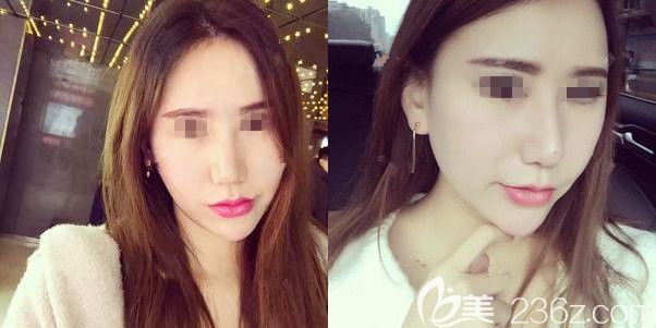 全麻做的自体脂肪面部填充全脸到今天一个月了