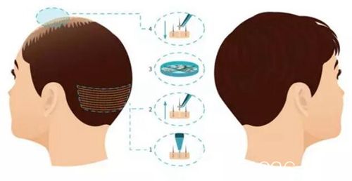 济南名韩微针植发技术 济南名韩微针植发技术