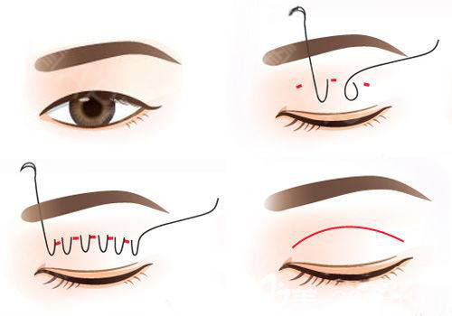 埋线法双眼皮手术示意图