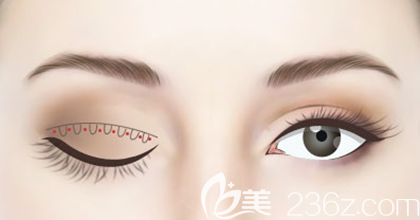 埋线法双眼皮效果图