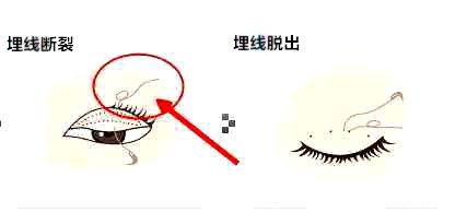 埋线断裂、脱出