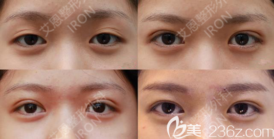 金承俊院长双眼皮案例