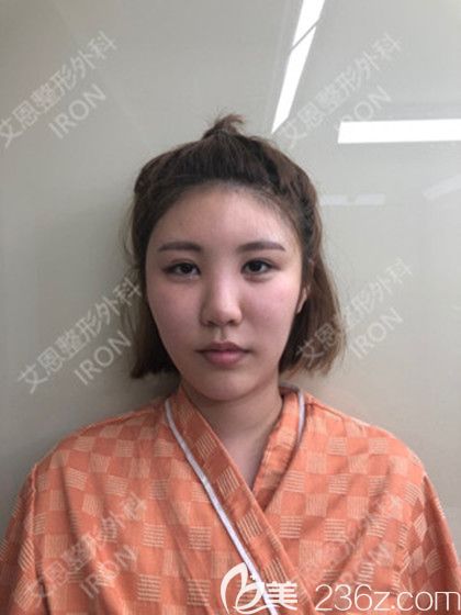 韩国艾恩鼻综合术前照 韩国艾恩鼻综合术前照