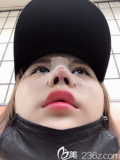 韩国艾恩鼻综合术后第3天 韩国艾恩鼻综合术后第3天