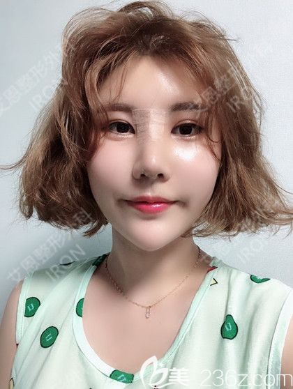 韩国艾恩鼻综合术后第7天 韩国艾恩鼻综合术后第7天