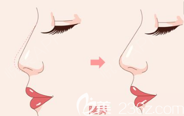 隆鼻前后对比图