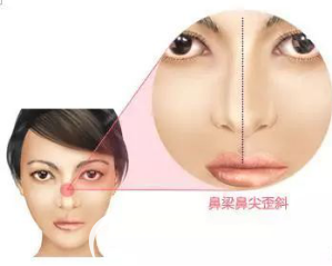 隆鼻后鼻梁鼻尖出现歪斜
