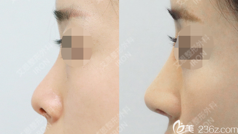 韩国艾恩整形隆鼻手术真人案例