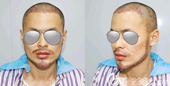 毛囊资源充足的我把发际线胡须鬓角一起种了 毛囊资源充足的我把发际线胡须鬓角一起种了