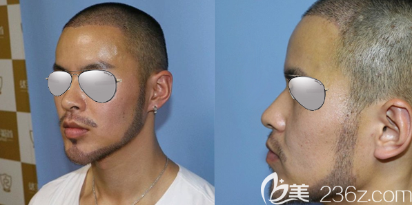 成都首瑞马天顺W型胡须种植术后7天恢复效果 成都首瑞马天顺W型胡须种植术后7天恢复效果