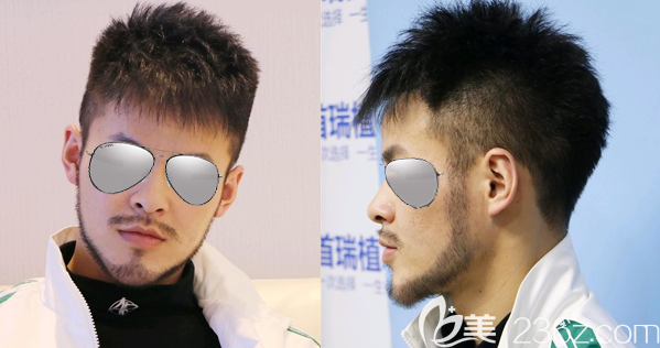 有了在成都首瑞种植w型胡须和鬓角种植的亲身经历，我轻松识破了“植胡须骗局”