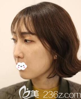 武汉硚口卓美吴秀英全脸埋线提升术前