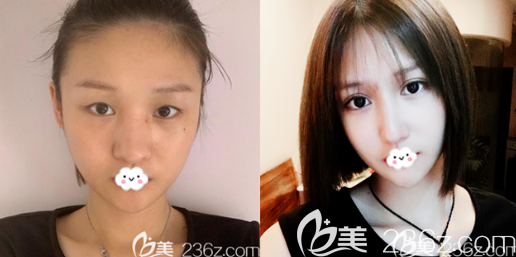 深圳富华医院金灵医生双眼皮案例 深圳富华医院金灵医生双眼皮案例