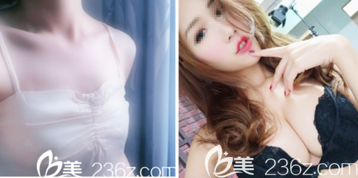 深圳富华整形医院胡俊杰假体隆胸案例 深圳富华整形医院胡俊杰假体隆胸案例