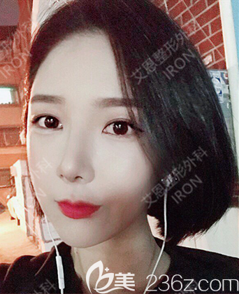 艾恩整形术后一个月 艾恩整形术后一个月