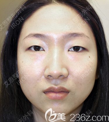 艾恩整形术前照 艾恩整形术前照