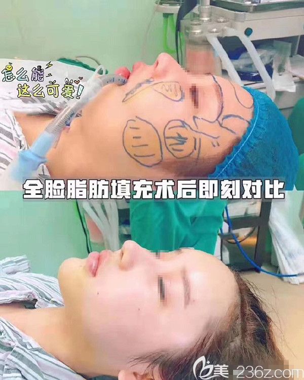 苏州金阊自体脂肪填充全面部即刻对比照 苏州金阊自体脂肪填充全面部即刻对比照