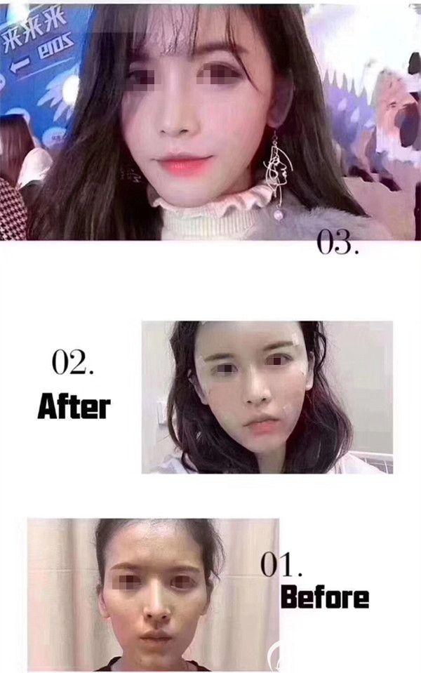 从术前到术中恢复阶段到术后半年的时间,改变效果明显 从术前到术中恢复阶段到术后半年的时间,改变效果明显