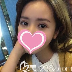 李院长做小眼综合术后25天疤痕逐渐淡化