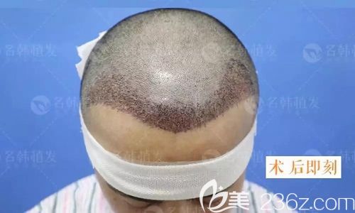 济南名韩植发术后即刻效果 济南名韩植发术后即刻效果