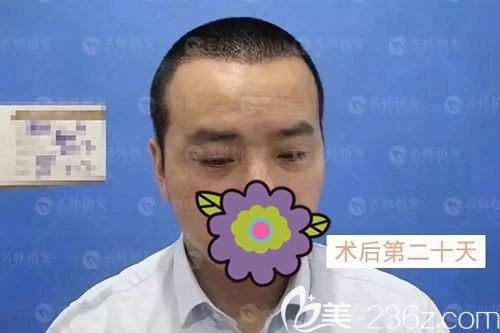 济南名韩做发际线种植术后20天 济南名韩做发际线种植术后20天