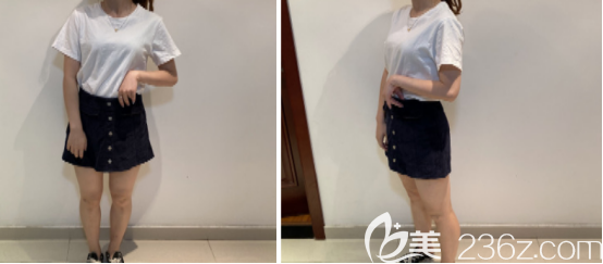 跟大家说说关于我去西安高一生做全身吸脂手术后的一些心里话 跟大家说说关于我去西安高一生做全身吸脂手术后的一些心里话