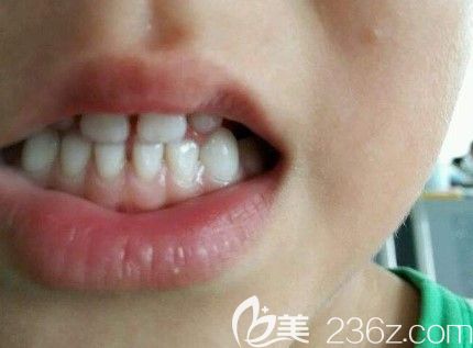 张海龙主任科普：孩子地包天戴牙套多久见效