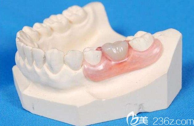 清远德艺口腔陈小骋医生解析：后牙有必要做全瓷冠吗