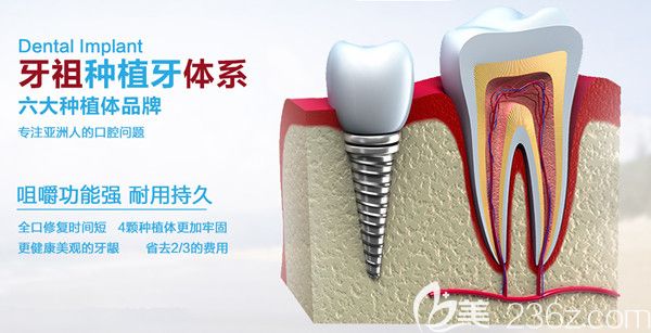 牙祖口腔种植体系 牙祖口腔种植体系