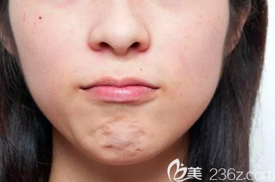 下巴吸脂术后凹凸不平